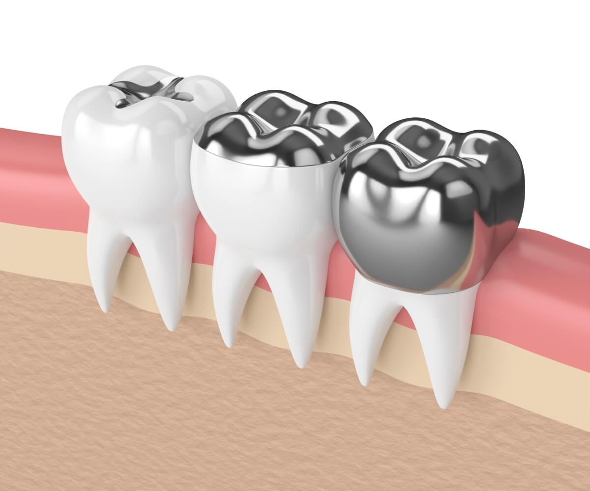 The safety of dental amalgam and alternative dental restoration