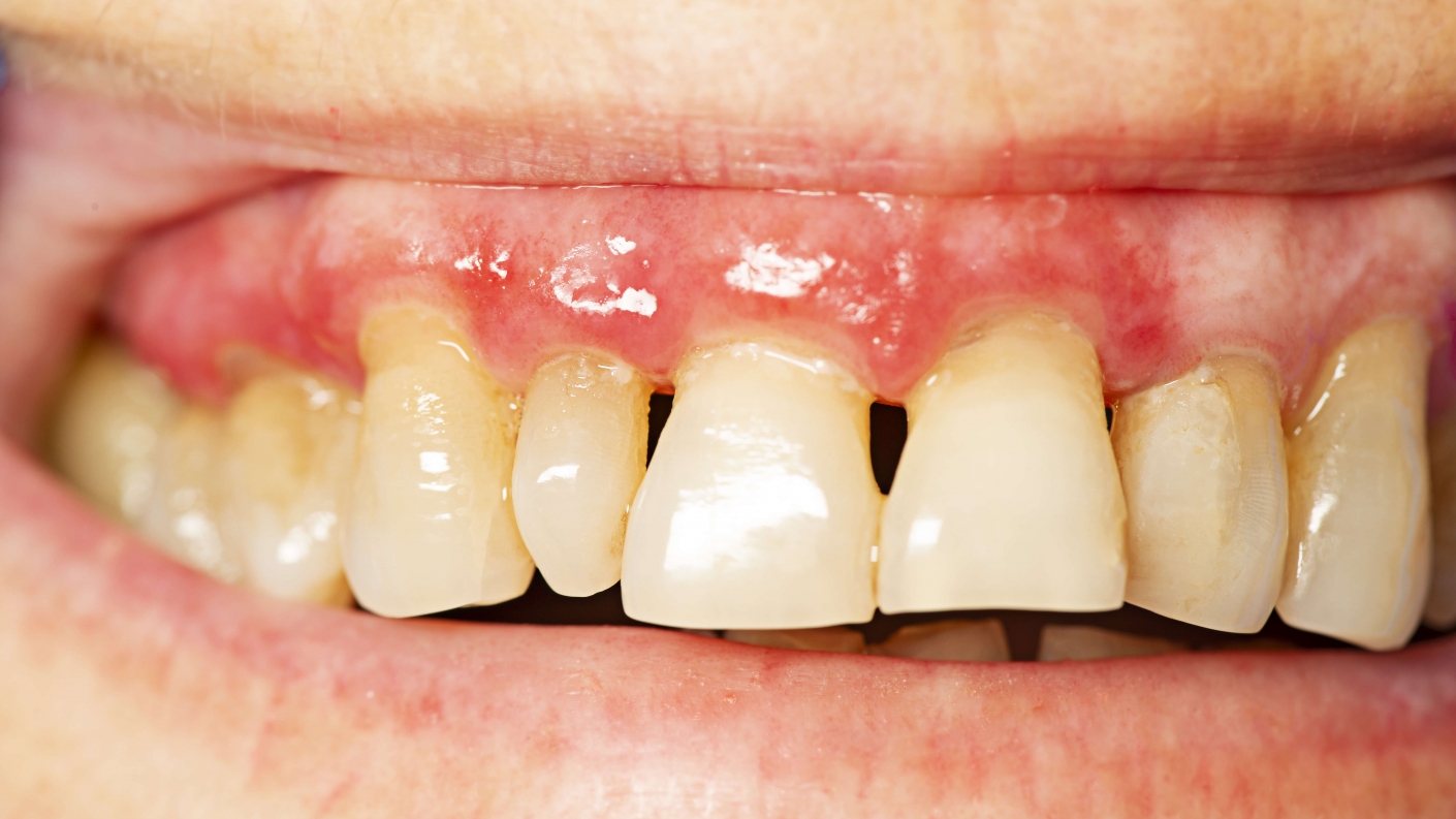 ODHA Dental Hygiene Newswire News and research for Ontario dental