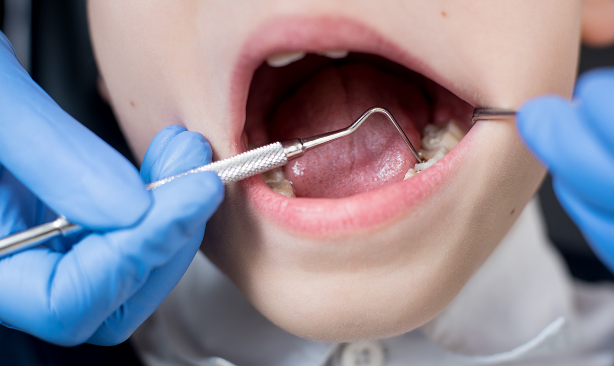 Pit and fissure sealants versus fluoride varnishes for preventing