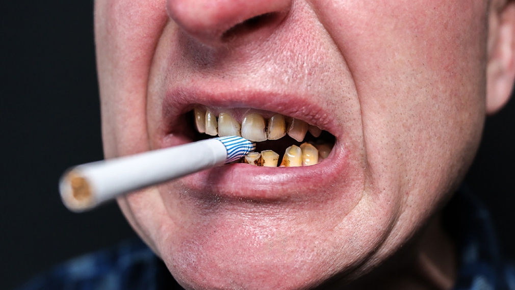 Effect of smoking on nonsurgical periodontal therapy