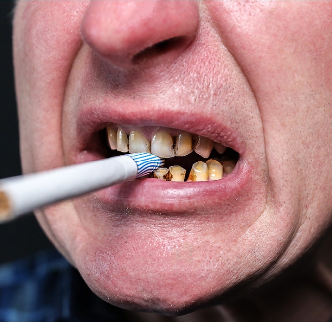 Effect of smoking on nonsurgical periodontal therapy
