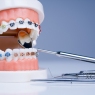 Oral self-care for periodontally healthy orthodontic clients