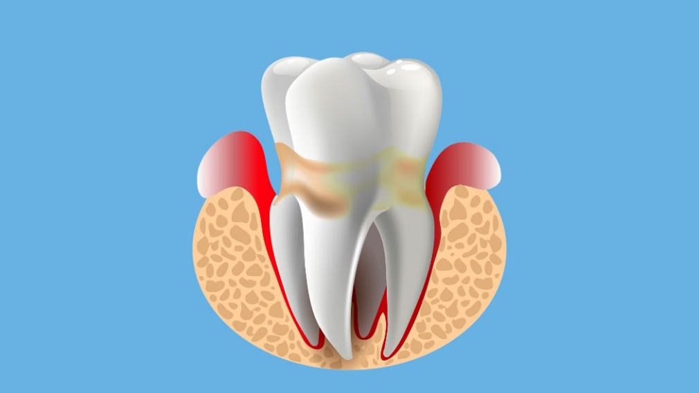 Successful treatment of periodontitis involves root surface decontamination and infection control in periodontal pockets. In the 1970s and 1980s, scaling, root planing, and gingival curettage were common treatments for periodontitis; and surgical treatments, such as gingivectomy, flap surgeries, and resective therapy, were often utilized. These therapies focused on soft tissue and bone removal due to the belief these tissues were contaminated during periodontitis, and their removal was necessary to control the disease. This paper reviews the approaches and concepts behind minimally invasive nonsurgical therapy (MINST) and presents some promising outcomes, namely: • Reduction of postoperative trauma, increasing tissue stability and consequent reduction in gingival margin changes; • Aesthetic benefits because of reduced gingival recession; and • Potentially reduced hypersensitivity posttreatment. Specifically, for intrabony defects and compared with surgical regenerative/reconstructive surgery, less invasive methods such as MINST may lead to: • Decreased chair time and healing time with a reduced impact on clients; • Minimal morbidity and tissue trauma; and • Similar average probing pocket depth reduction and clinical attachment level gains.