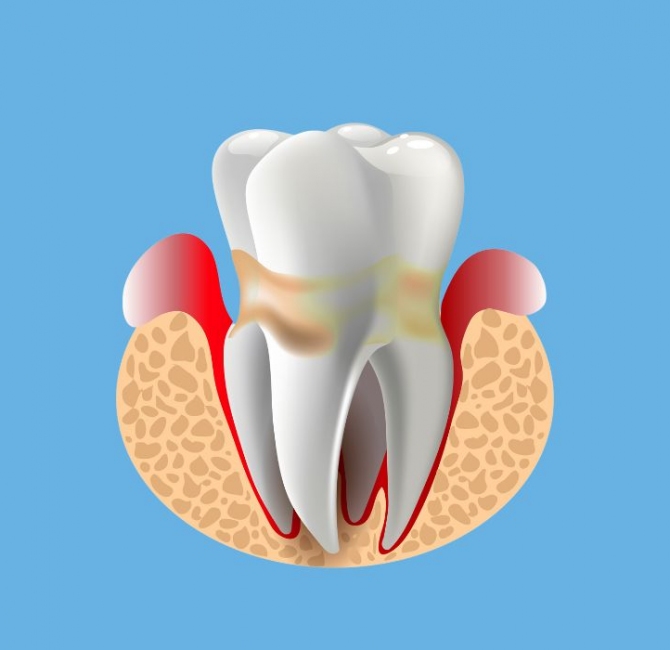 Successful treatment of periodontitis involves root surface decontamination and infection control in periodontal pockets. In the 1970s and 1980s, scaling, root planing, and gingival curettage were common treatments for periodontitis; and surgical treatments, such as gingivectomy, flap surgeries, and resective therapy, were often utilized. These therapies focused on soft tissue and bone removal due to the belief these tissues were contaminated during periodontitis, and their removal was necessary to control the disease. This paper reviews the approaches and concepts behind minimally invasive nonsurgical therapy (MINST) and presents some promising outcomes, namely: • Reduction of postoperative trauma, increasing tissue stability and consequent reduction in gingival margin changes; • Aesthetic benefits because of reduced gingival recession; and • Potentially reduced hypersensitivity posttreatment. Specifically, for intrabony defects and compared with surgical regenerative/reconstructive surgery, less invasive methods such as MINST may lead to: • Decreased chair time and healing time with a reduced impact on clients; • Minimal morbidity and tissue trauma; and • Similar average probing pocket depth reduction and clinical attachment level gains.