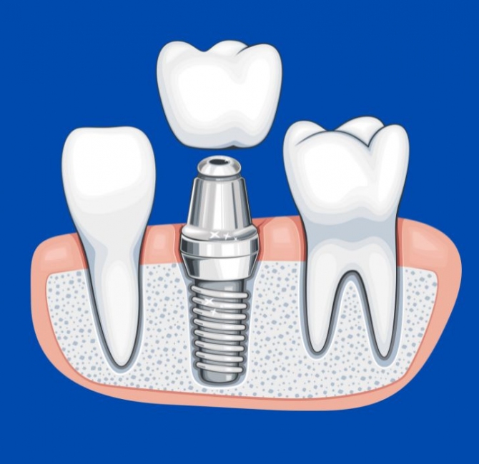 What every dental practitioner should know about how to examine patients with dental implants
