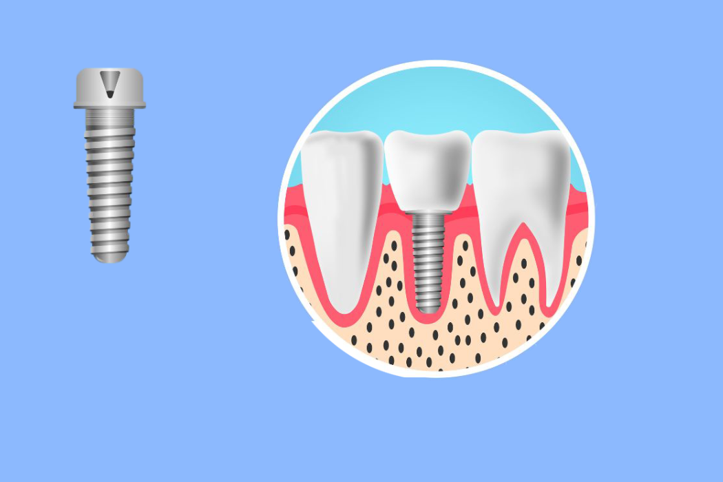 Peri-implant diseases