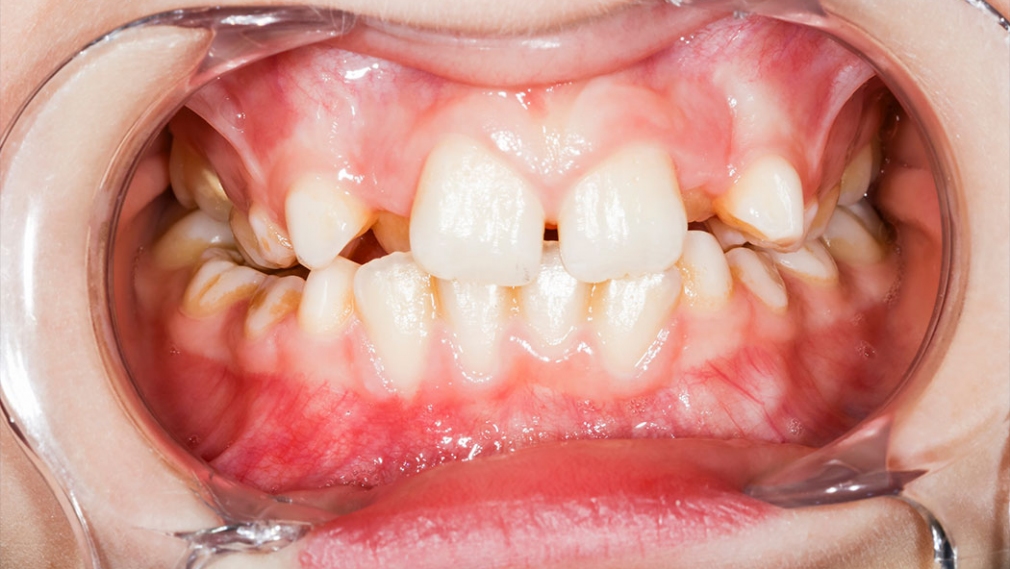 Detecting dental caries on photographs