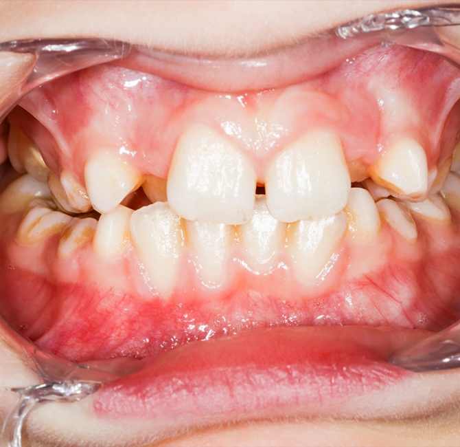 Detecting dental caries on photographs