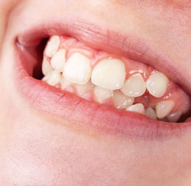 Periodontal conditions in pediatric clients