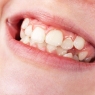 Periodontal conditions in pediatric clients