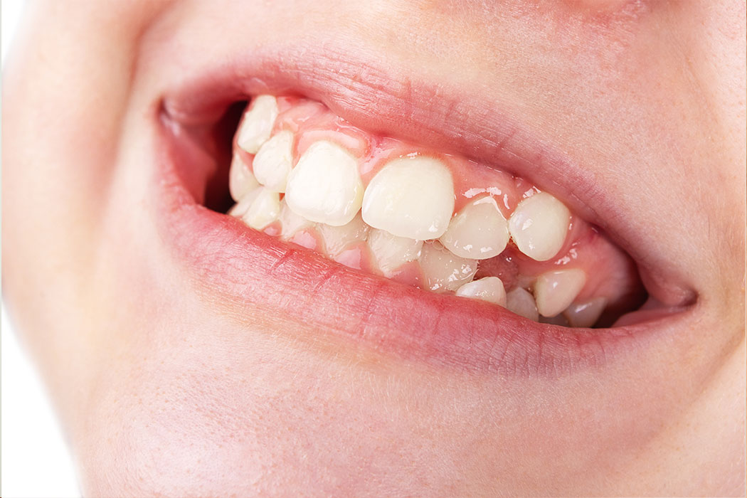 Periodontal conditions in pediatric clients