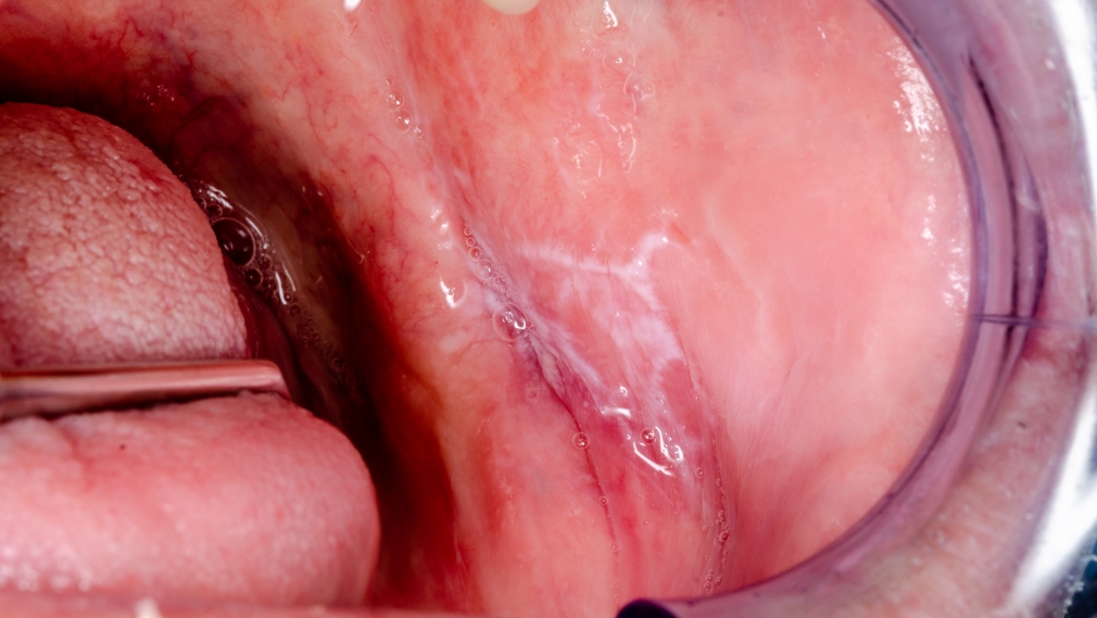 Oral lichen planus and lichenoid lesions - challenges and pitfalls for the general dental