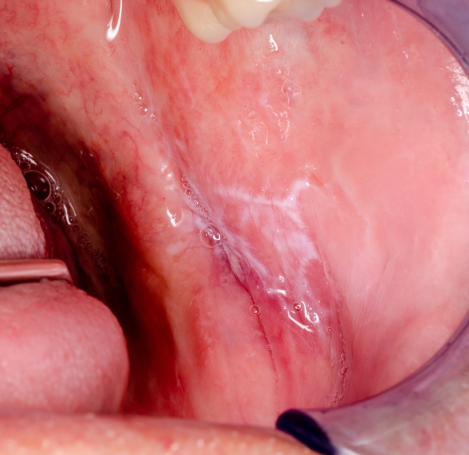 Oral lichen planus and lichenoid lesions - challenges and pitfalls for the general dental