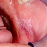 Oral lichen planus and lichenoid lesions