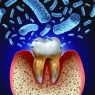 Periodontal disease: A systemic condition