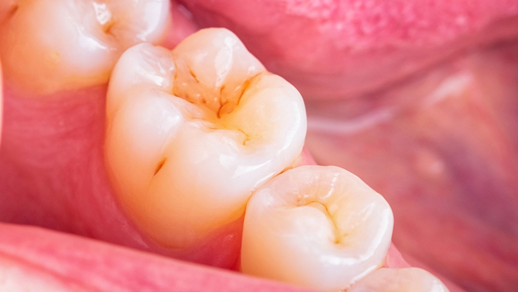 Evidence-based approaches and considerations for nonrestorative treatments within modern caries management