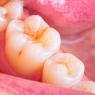 Evidence-based nonrestorative treatments for dental caries management