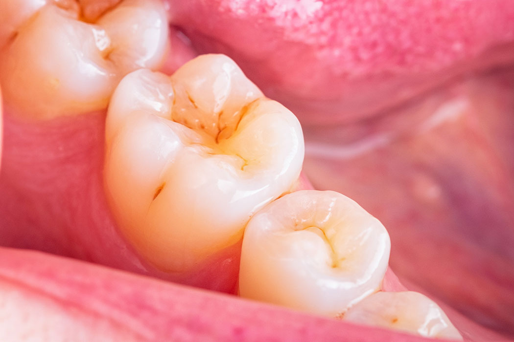 Evidence-based approaches and considerations for nonrestorative treatments within modern caries management