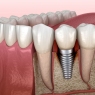 AO/AAP peri-implant diseases prevention and management consensus summary report