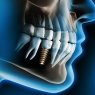 AO/AAP consensus on peri-implant disease prevention and management: Clinical translation