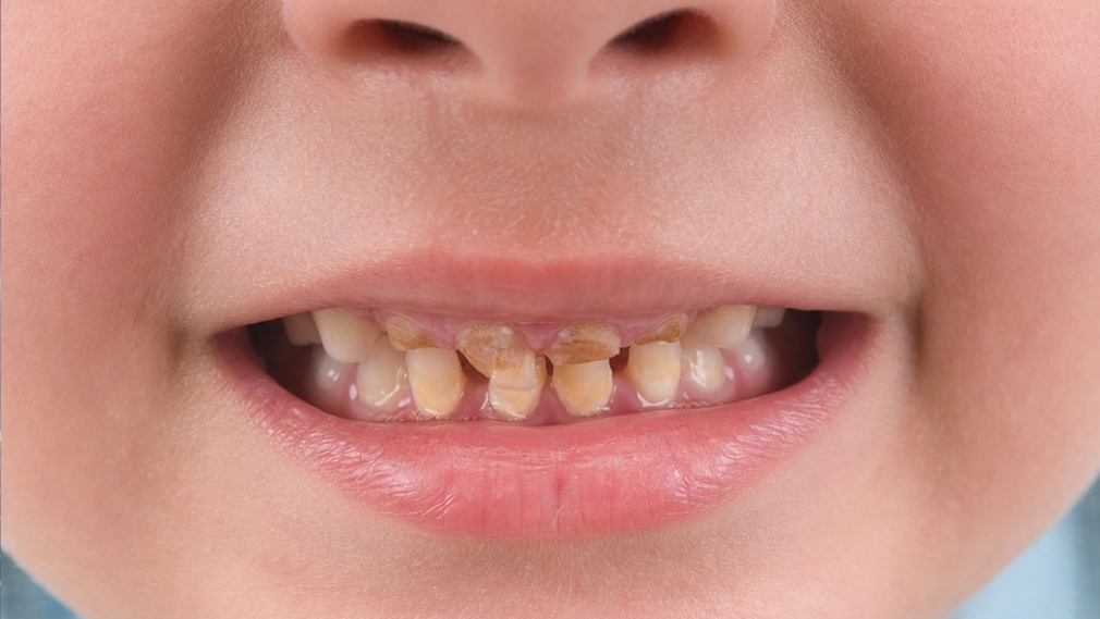Childhood oral health associated with cardiovascular disease in adulthood