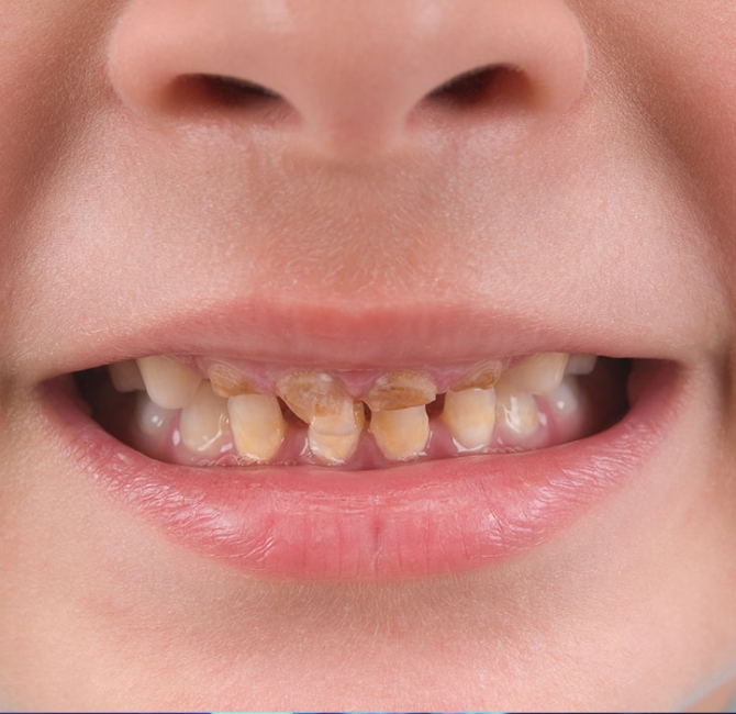 Childhood oral health associated with cardiovascular disease in adulthood