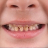 Childhood oral health associated with cardiovascular disease in adulthood