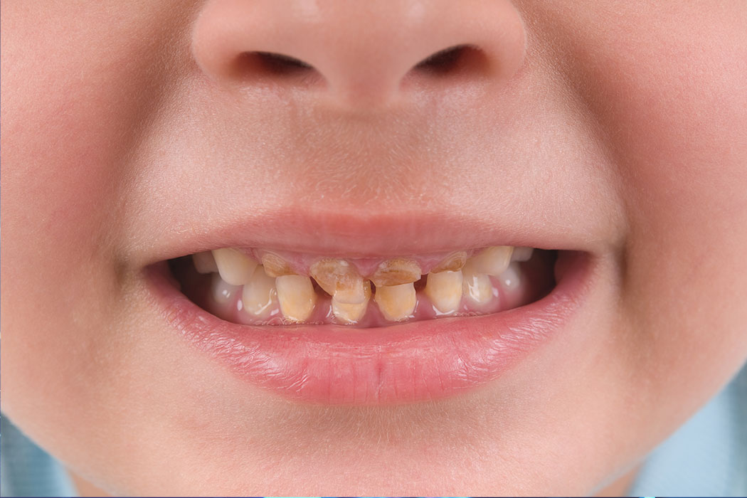 Childhood oral health associated with cardiovascular disease in adulthood