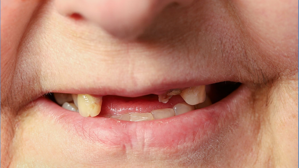 Missing teeth, mortality, and hospitalization: A population-based cohort analysis from the Canadian Health Measures Survey and linked databases