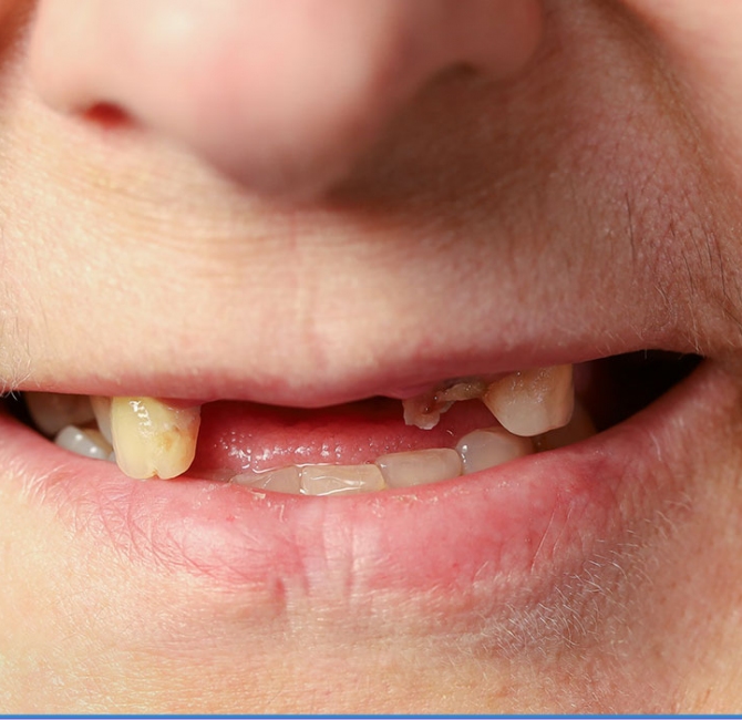 Missing teeth, mortality, and hospitalization: A population-based cohort analysis from the Canadian Health Measures Survey and linked databases