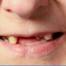 Tooth loss and hospitalization among Canadian adults
