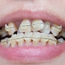 Orthodontic therapy and periodontitis