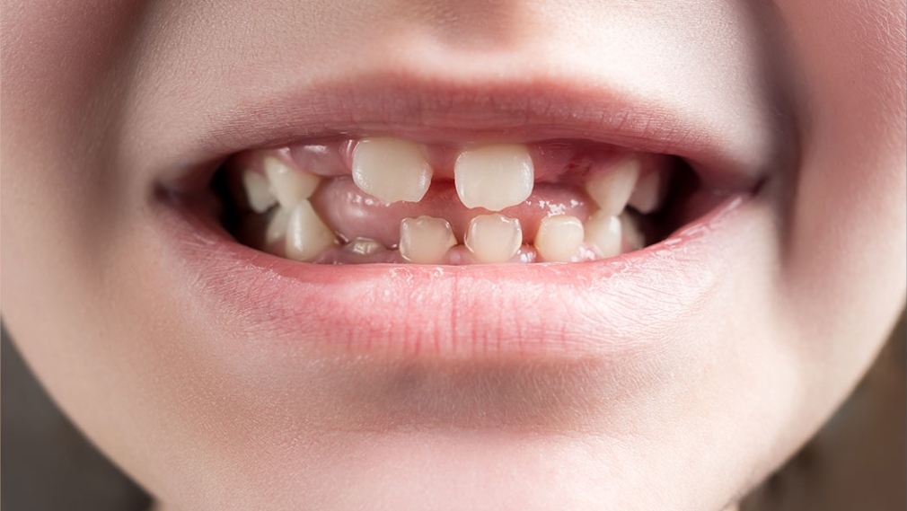Consensus report on periodontal diseases in children and adolescents