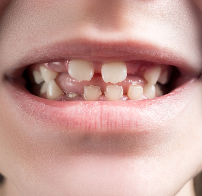 Consensus report on periodontal diseases in children and adolescents