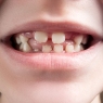 Consensus report on periodontal diseases in children and adolescents