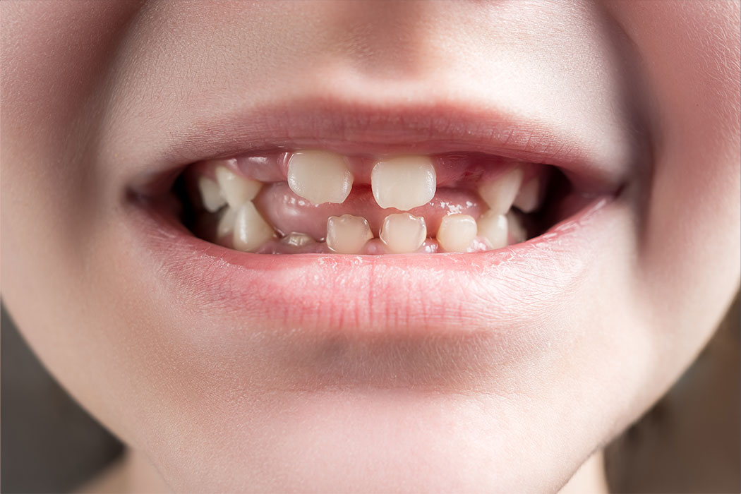 Consensus report on periodontal diseases in children and adolescents