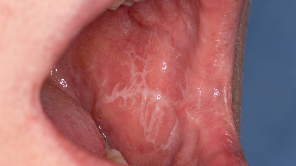 Oral lichen planus and systemic diseases