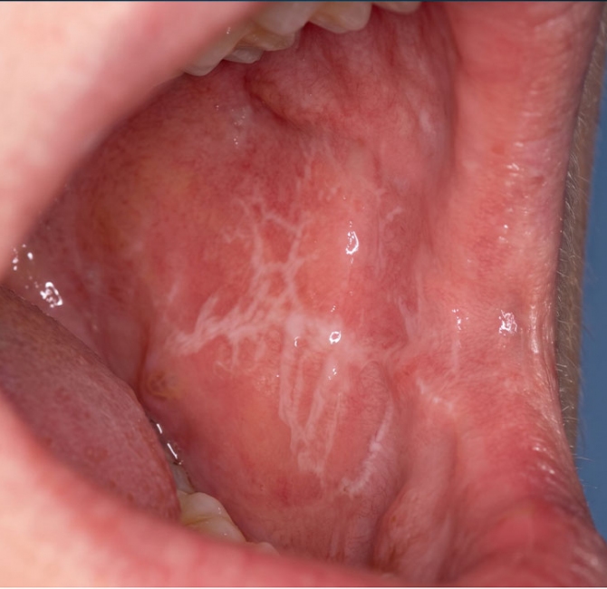 Oral lichen planus and systemic diseases