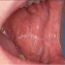 Oral lichen planus and systemic diseases
