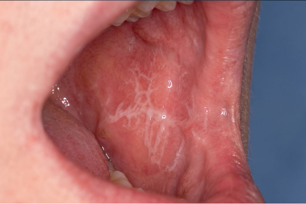 Oral lichen planus and systemic diseases