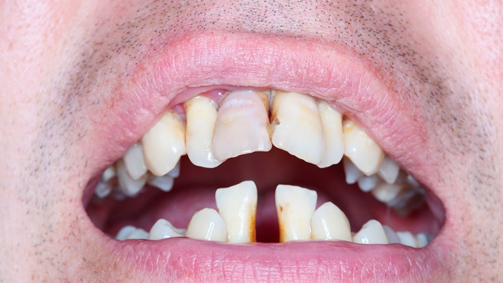 Stage IV periodontitis clinical practice guideline
