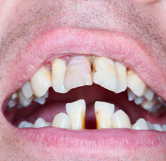 Stage IV periodontitis clinical practice guideline