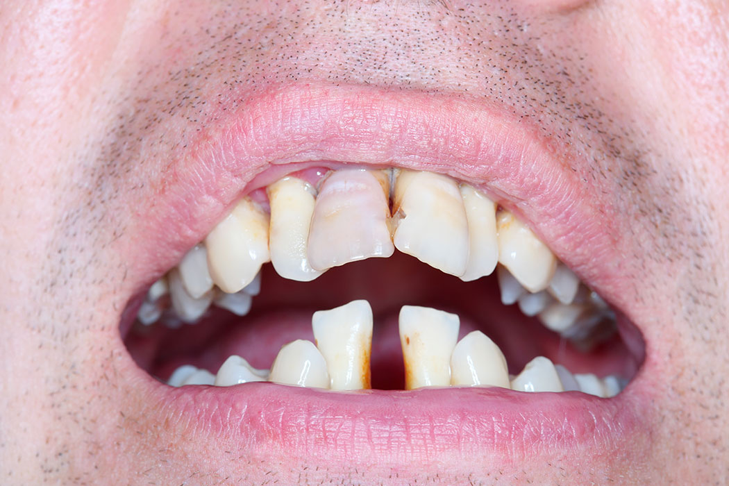 Stage IV periodontitis clinical practice guideline
